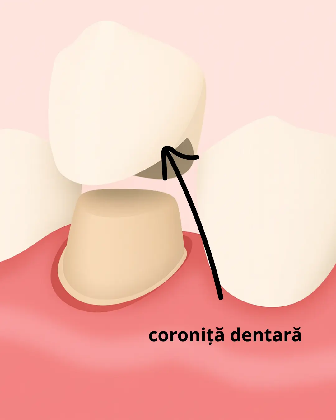 Coronițe dentare -cabinet stomatologic focsani (1)